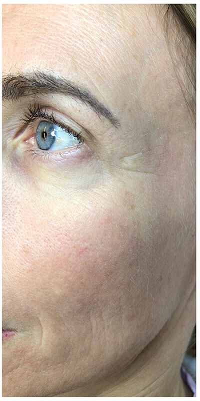 Nachher: Augenpartie einer Kundin vor und nach dem Fusion Microneedling